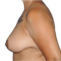 Mommy Makeover Before & After Patient #433