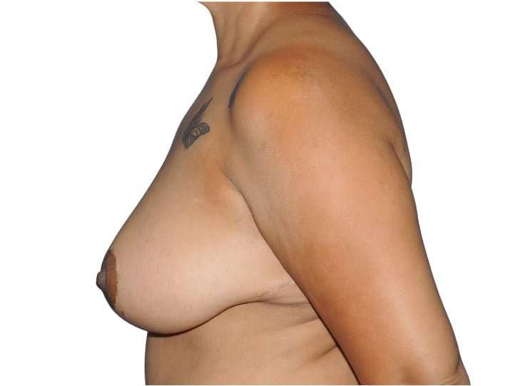 Mommy Makeover Before & After Patient #433