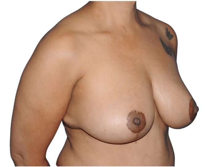 Mommy Makeover Before & After Patient #433