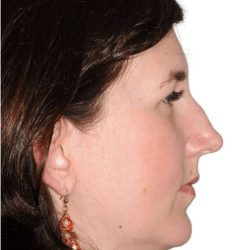 Rhinoplasty Before & After Patient #418