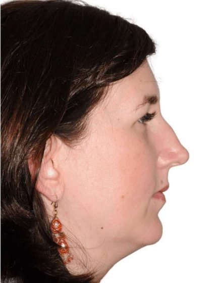 Rhinoplasty Before & After Patient #418