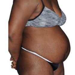 Tummy Tuck Before & After Patient #478