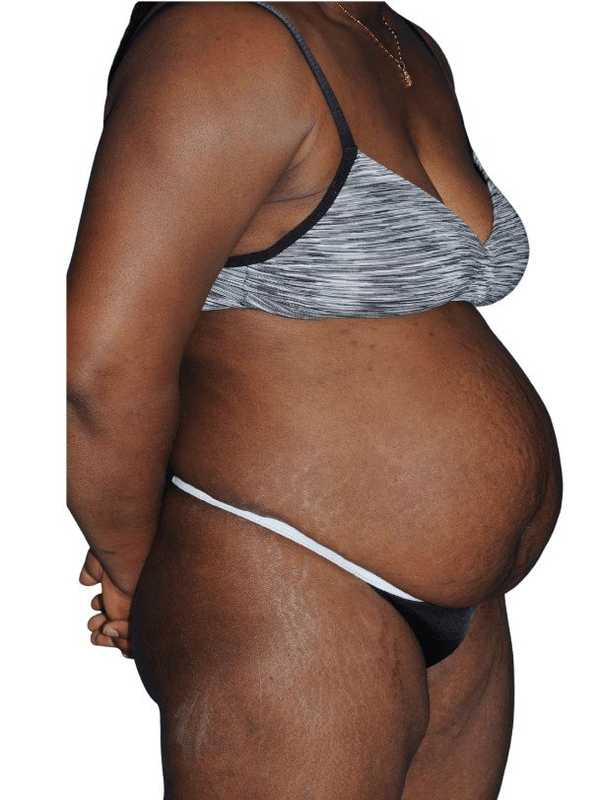 Tummy Tuck Before & After Patient #478