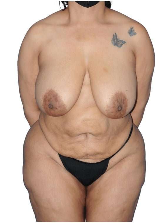 Tummy Tuck Before & After Patient #493