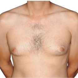 Gynecomastia Before & After Patient #515