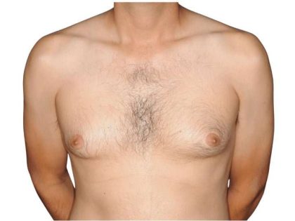 Gynecomastia Before & After Patient #515