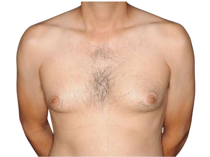Gynecomastia Before & After Patient #515
