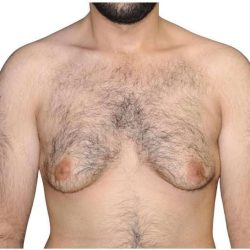 Gynecomastia Before & After Patient #525