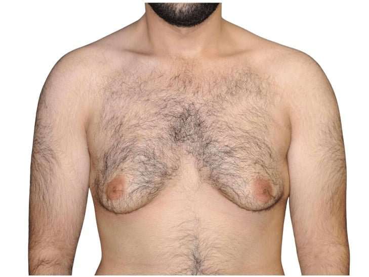 Gynecomastia Before & After Patient #525