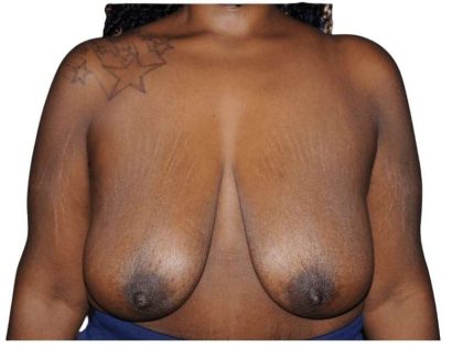 Breast Lift Before & After Patient #538