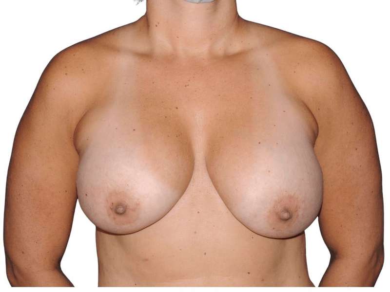 Breast Lift Before & After Patient #559