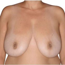 Breast Lift Before & After Patient #565
