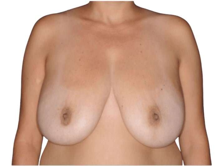 Breast Lift Before & After Patient #565