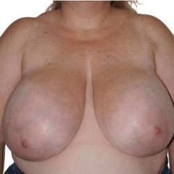 Breast Reduction Before & After Patient #579