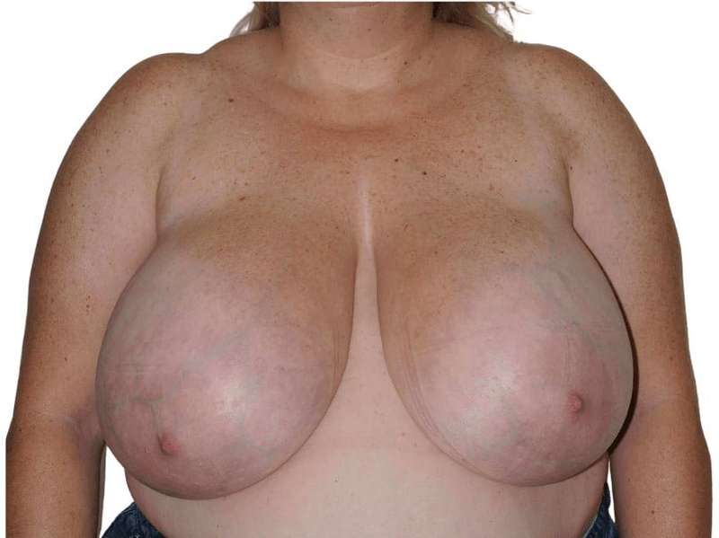 Breast Reduction Before & After Patient #579