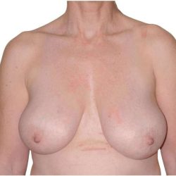 Breast Reduction Before & After Patient #586
