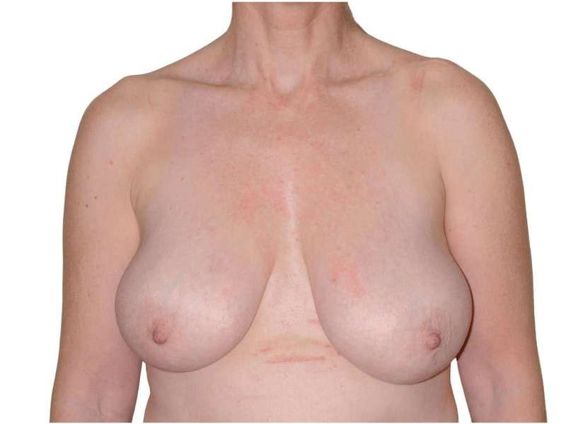 Breast Reduction Before & After Patient #586