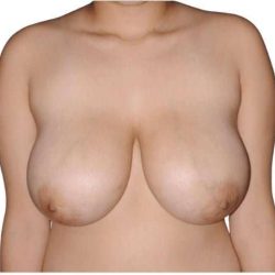 Breast Reduction Before & After Patient #593