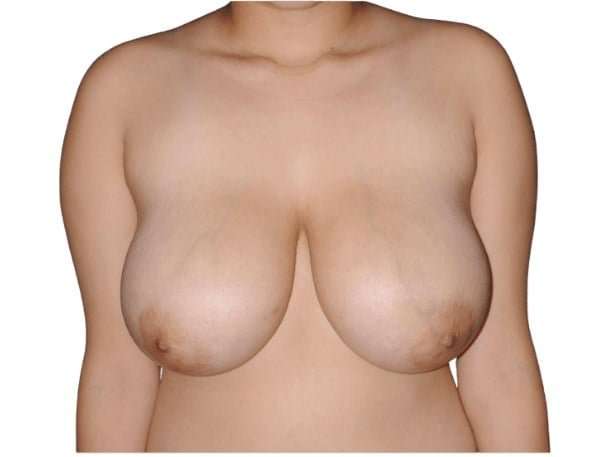 Breast Reduction Before & After Patient #593