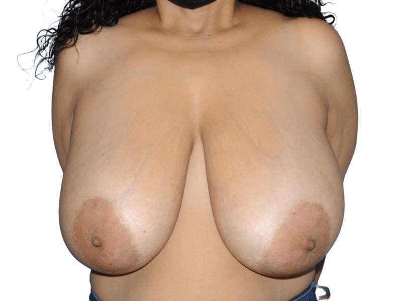 Breast Reduction Before & After Patient #610