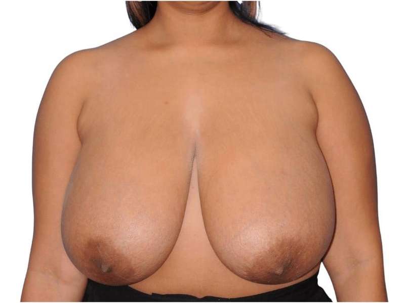Breast Reduction Before & After Patient #617