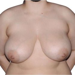 Breast Reduction Before & After Patient #624