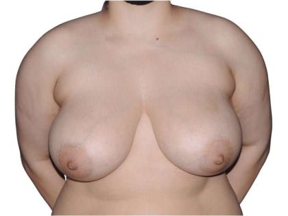 Breast Reduction Before & After Patient #624
