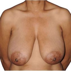 Breast Reduction Before & After Patient #630