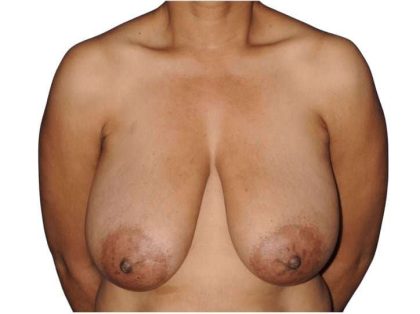 Breast Reduction Before & After Patient #630