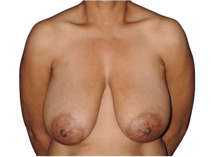 Breast Reduction Before & After Patient #630