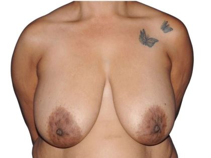 Breast Reduction Before & After Patient #635