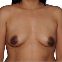 Breast Augmentation Before & After Patient #663