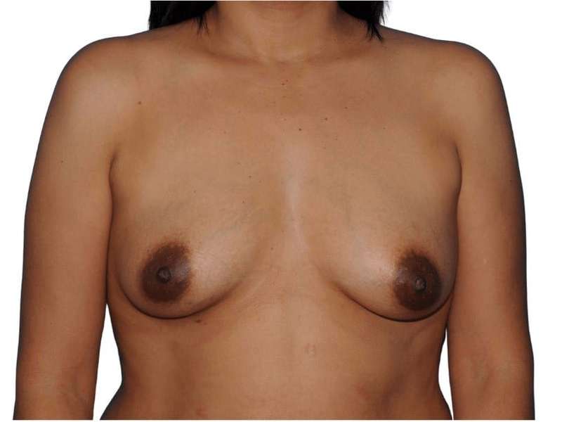 Breast Augmentation Before & After Patient #663