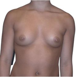 Breast Augmentation Before & After Patient #670