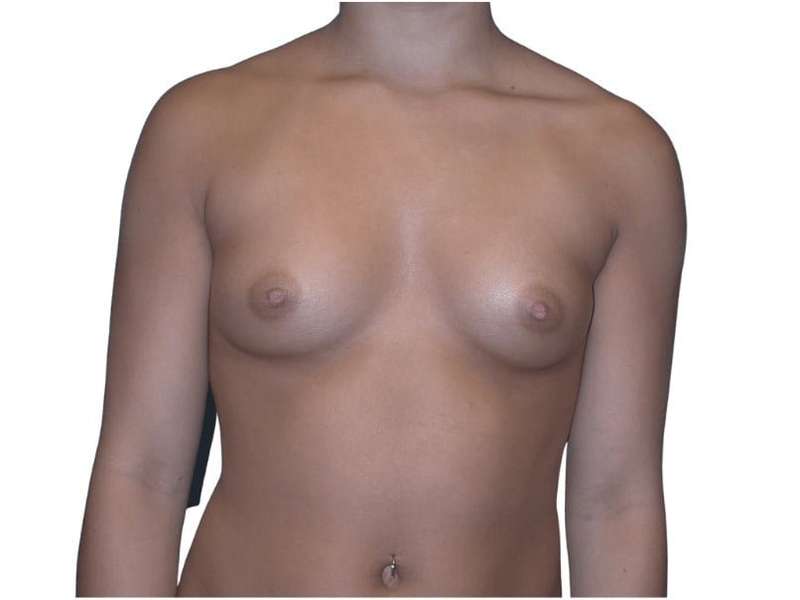 Breast Augmentation Before & After Patient #670