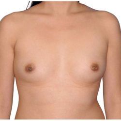 Breast Augmentation Before & After Patient #679