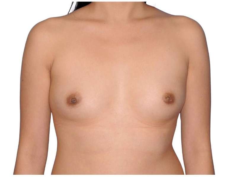 Breast Augmentation Before & After Patient #679