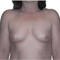Breast Augmentation Before & After Patient #686