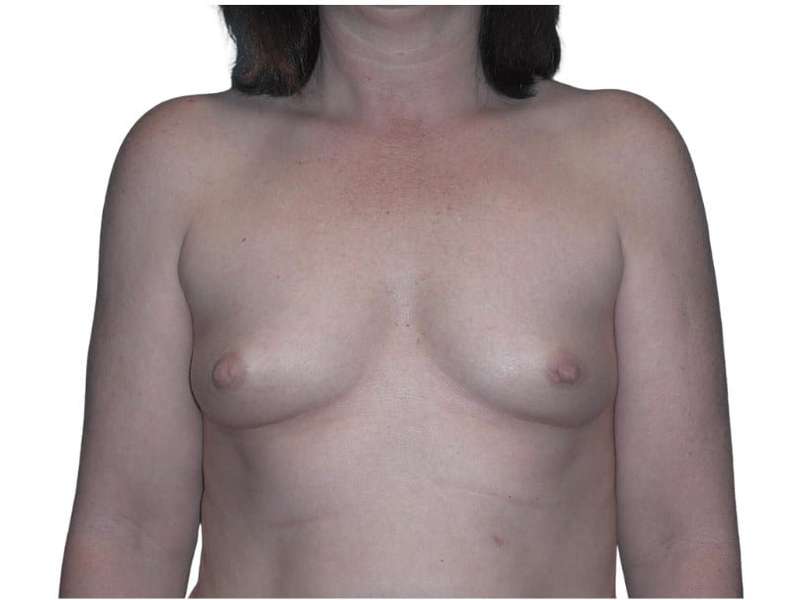 Breast Augmentation Before & After Patient #686