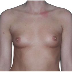 Breast Augmentation Before & After Patient #693