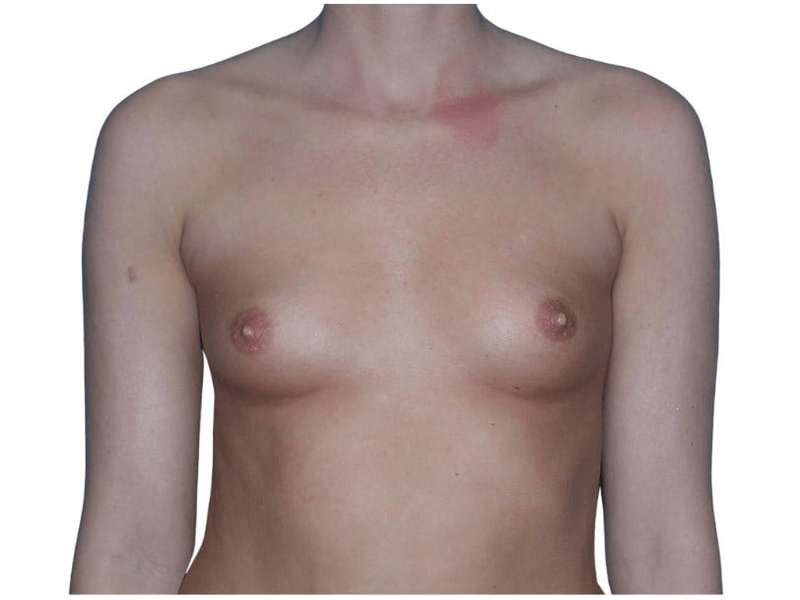 Breast Augmentation Before & After Patient #693