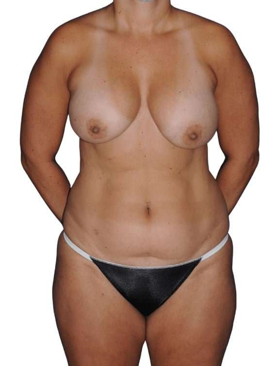 Liposuction Before & After Patient #445