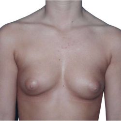 Breast Augmentation Before & After Patient #700