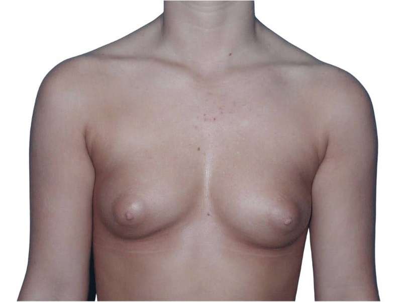 Breast Augmentation Before & After Patient #700