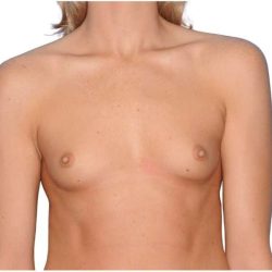Breast Augmentation Before & After Patient #707