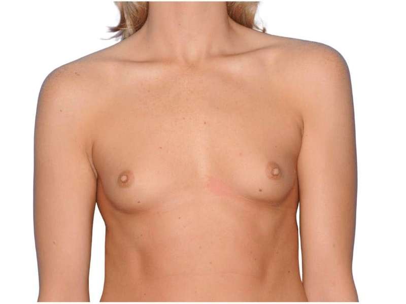 Breast Augmentation Before & After Patient #707