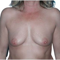 Breast Augmentation Before & After Patient #714