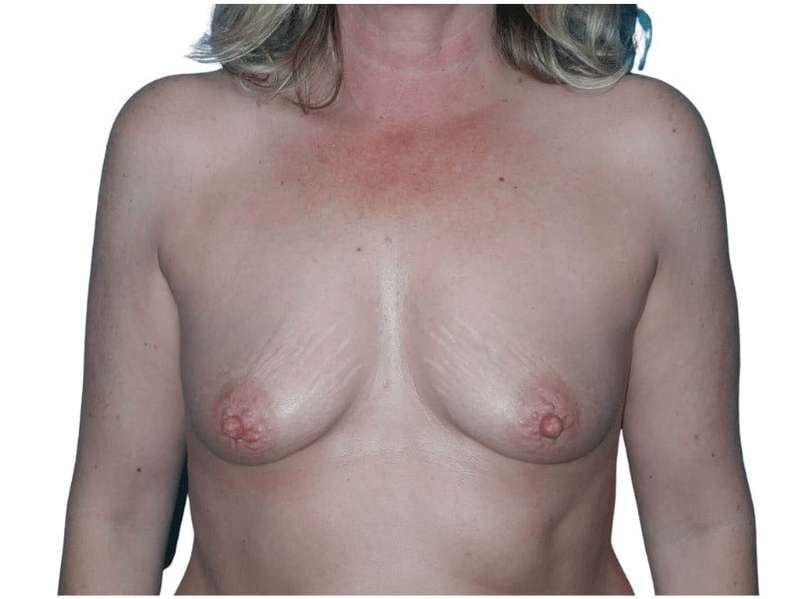 Breast Augmentation Before & After Patient #714