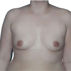 Breast Augmentation Before & After Patient #721