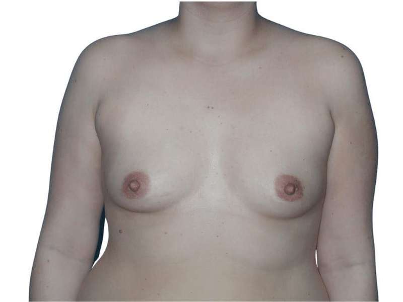 Breast Augmentation Before & After Patient #721
